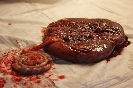 Placenta with marginal cord insertion 